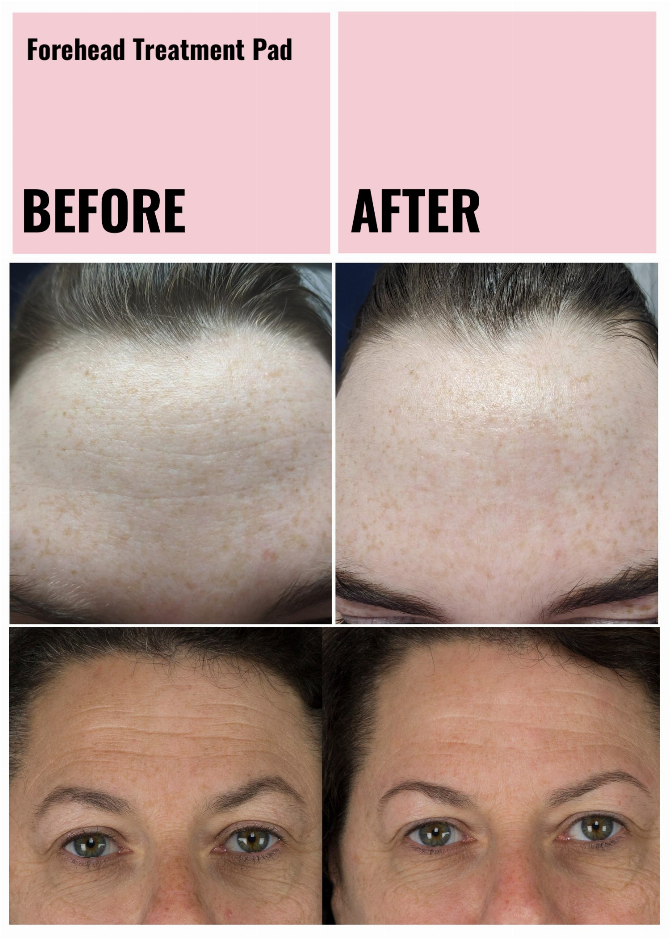 Ageless Beauty Skin Plumping Treatment Pads Wholesale Starter Kit