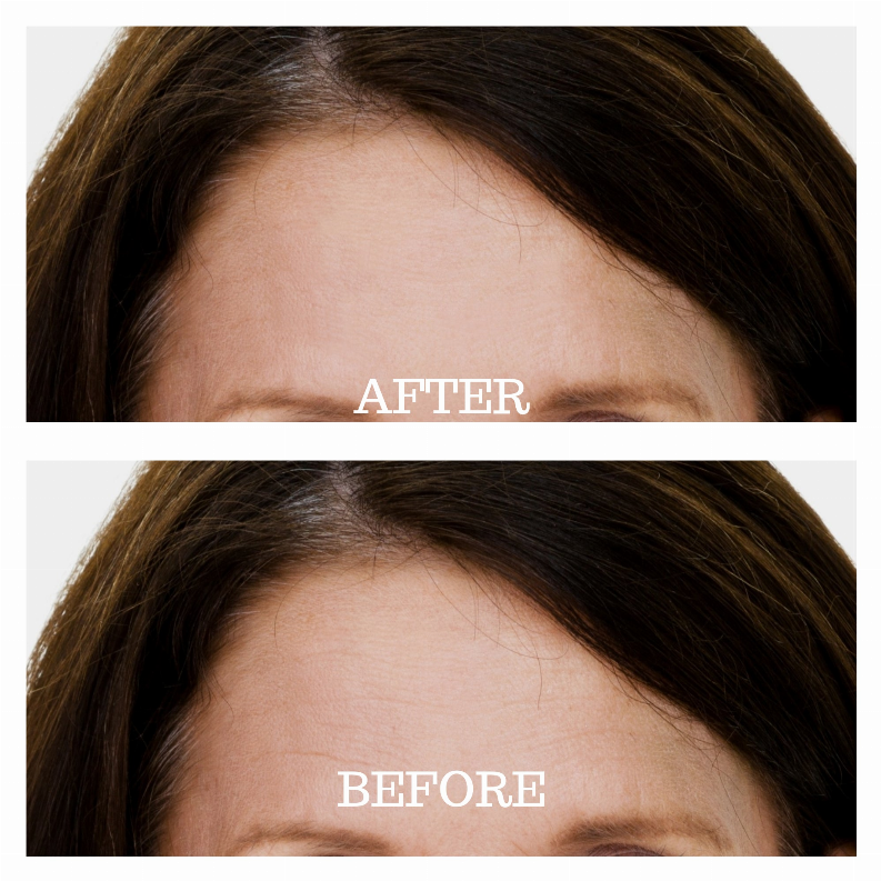 Skin Plumping Reusable Forehead Treatment Pad