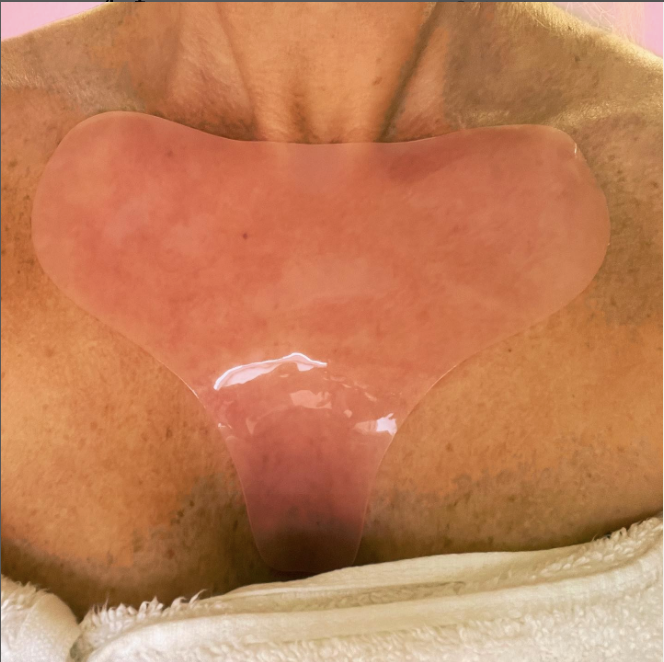 Hydra Reusable Chest Patch