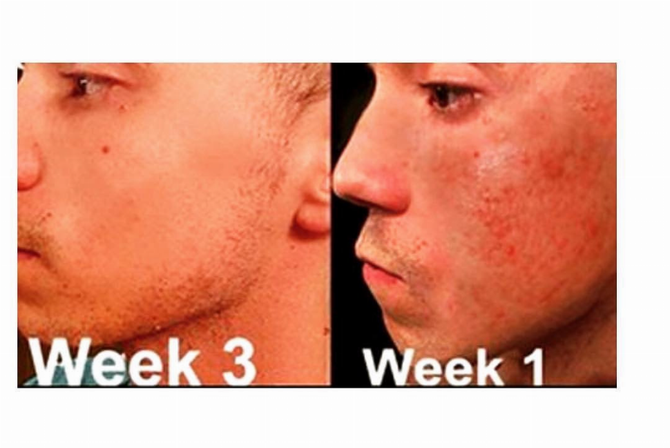 Acne Spot Treatment