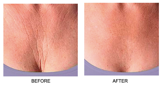 Skin Plumping Reusable Chest Treatment Pad